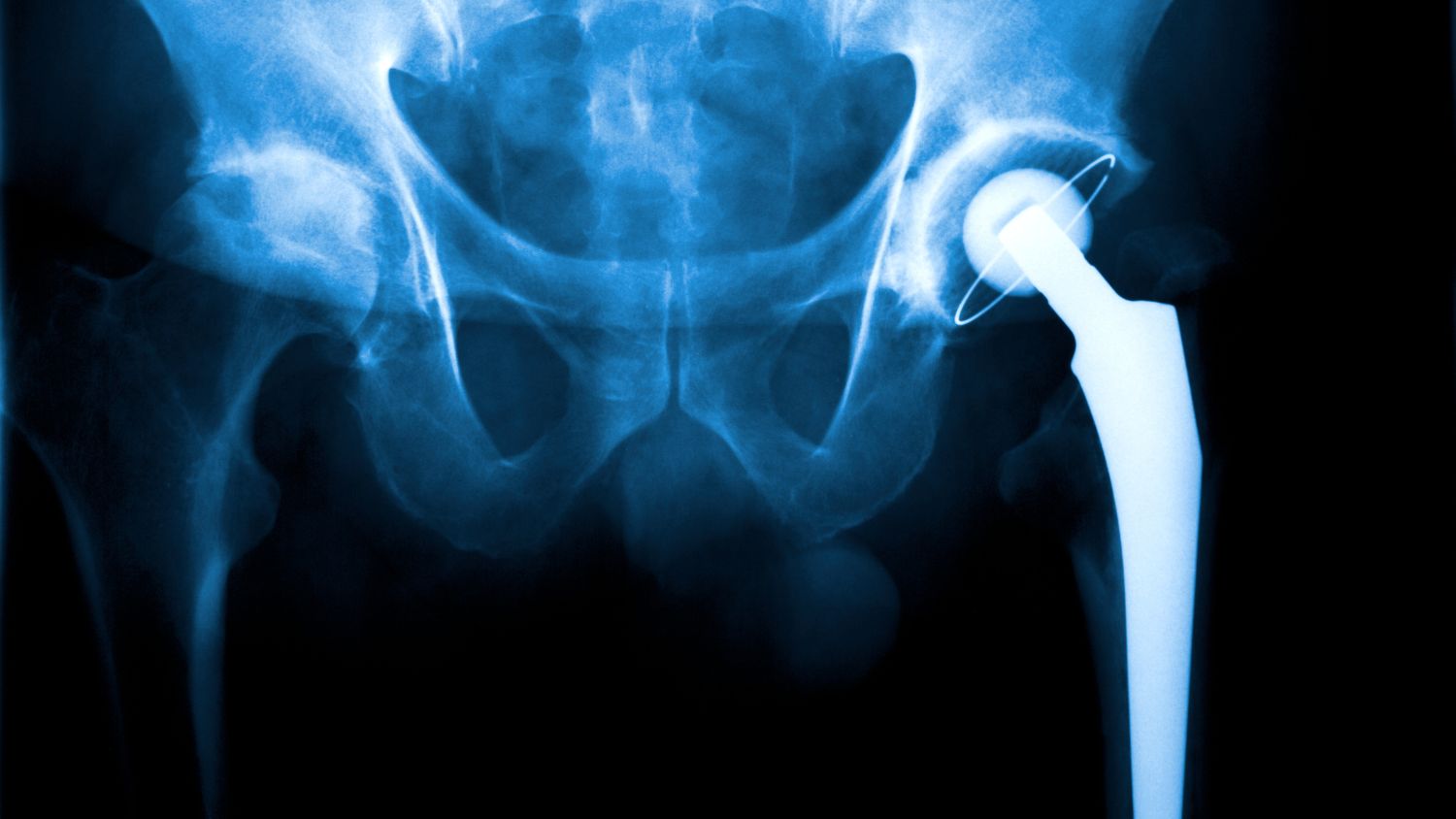 Titanium Wire in Orthopaedic Implants -  Why the Body Bonds to It