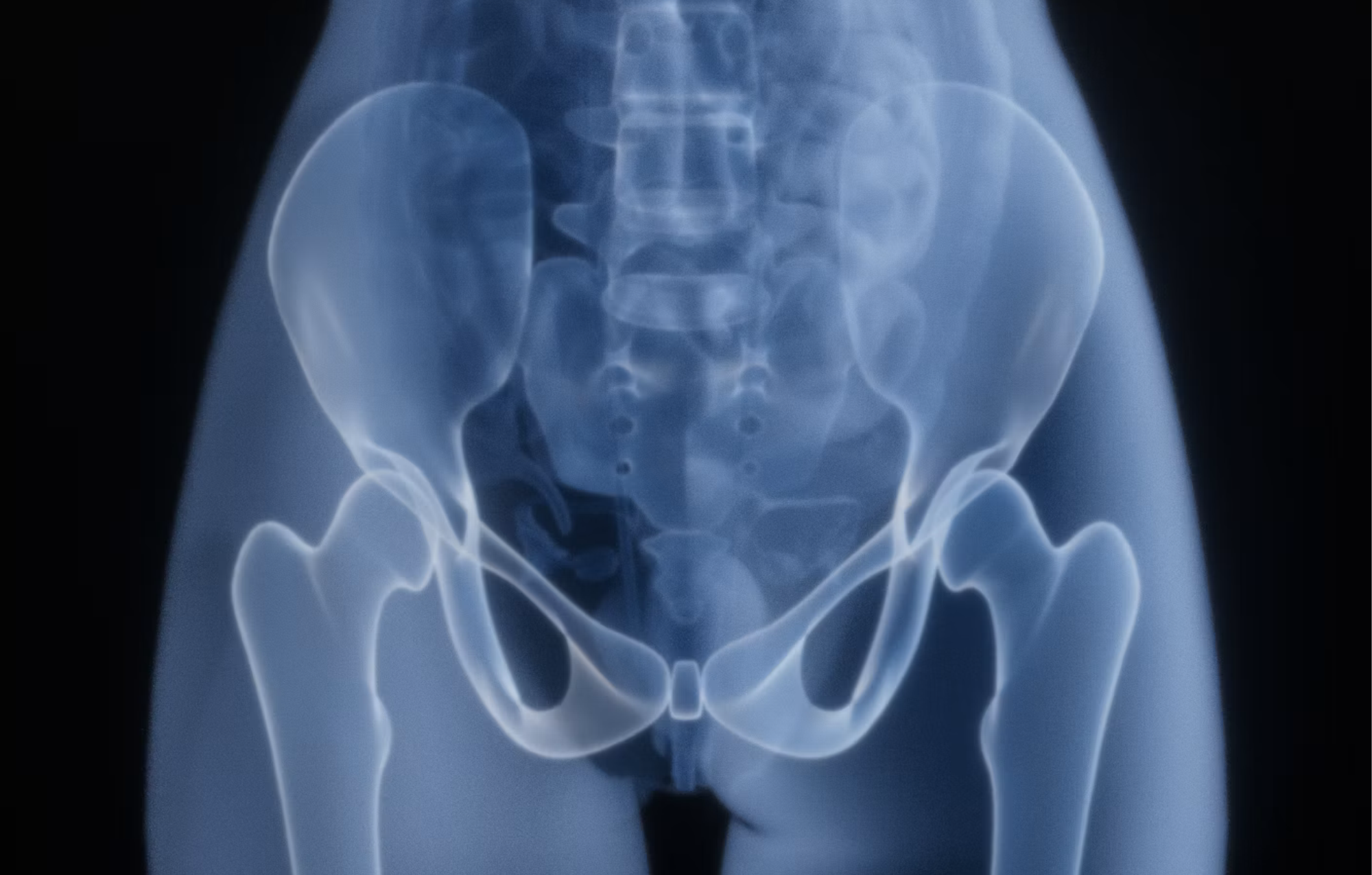 How Tantalum Gets Bone to Grow Into an Implant