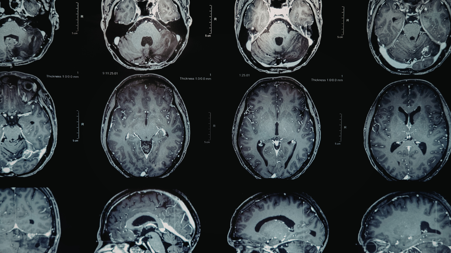 Tungsten Microelectrodes Help Map How Early Alzheimer’s Pathology Spreads Through the Brain