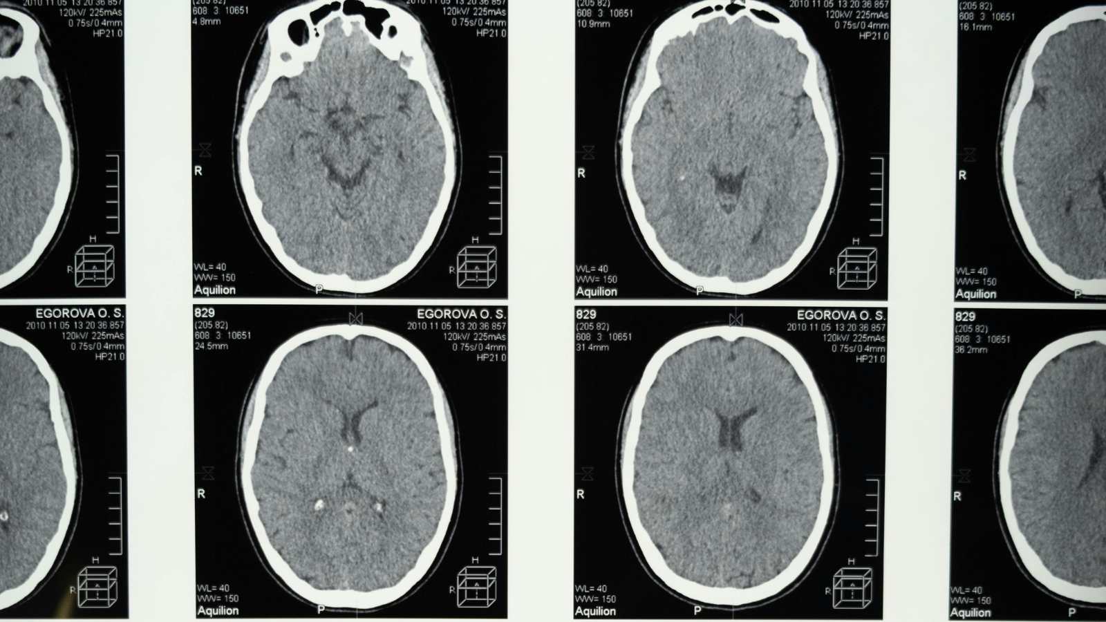 Case Study: Custom Electrodes Using 99.99% Silver Wire and Platinum/Iridium Wire for Deep-Brain Stimulation Research